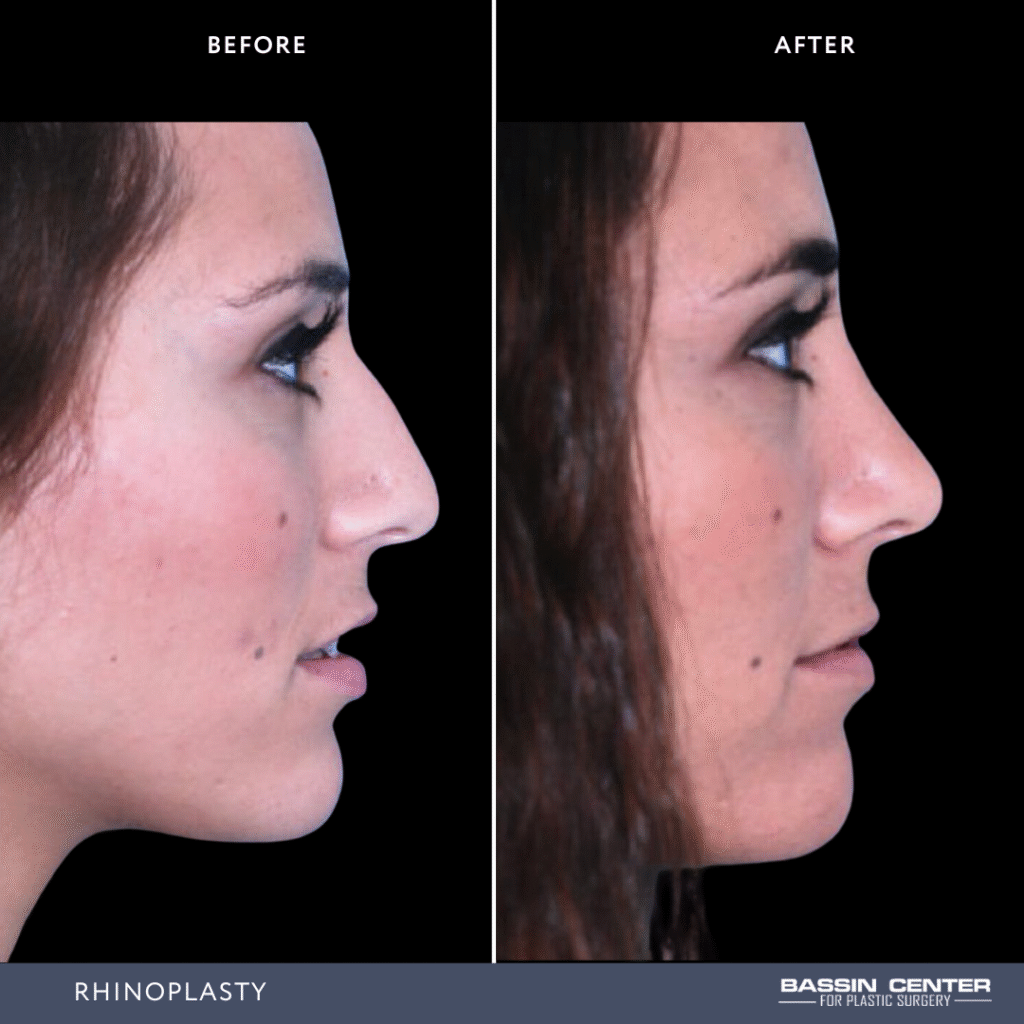 Before and After Image: Rhinoplasty - right-side