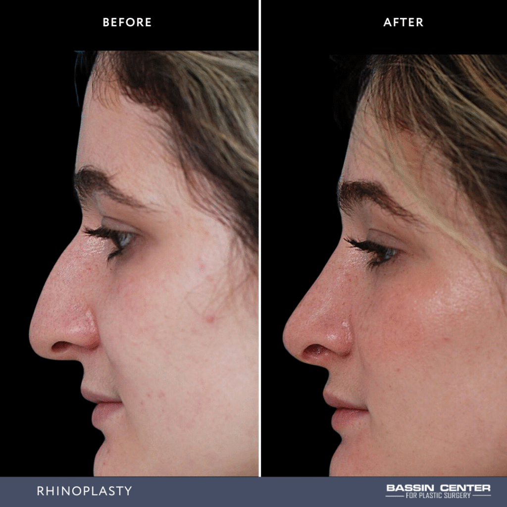 Before and After Image: Rhinoplasty - left-side