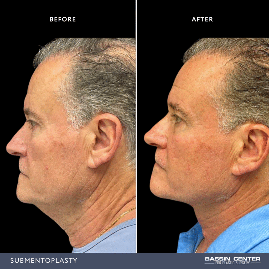 Before and After Image: Submentoplasty - left-side