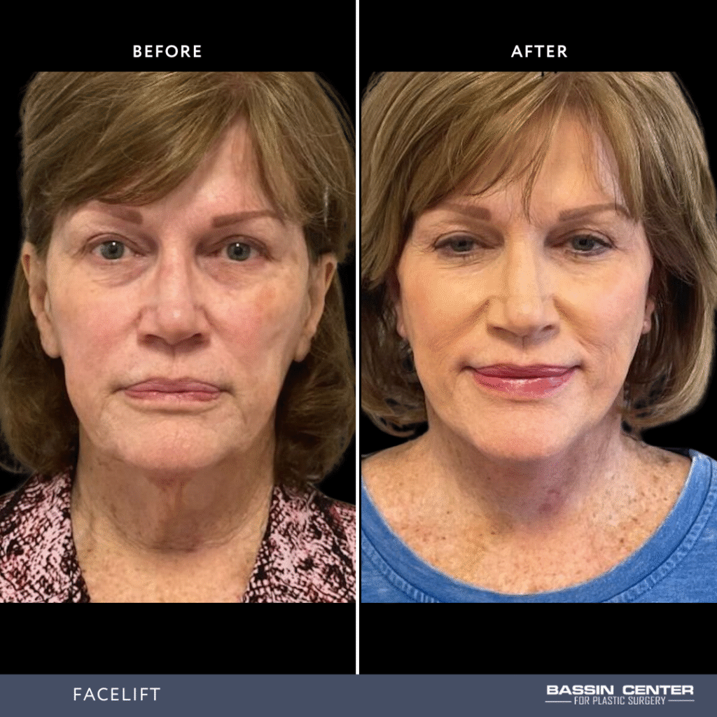 Before and After Image: Facelift - front