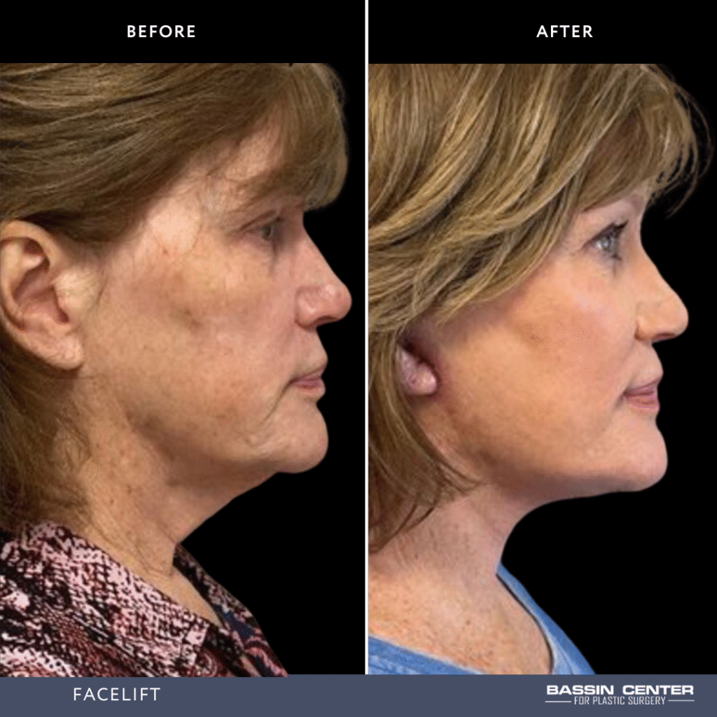Before and After Image: Facelift - right-side