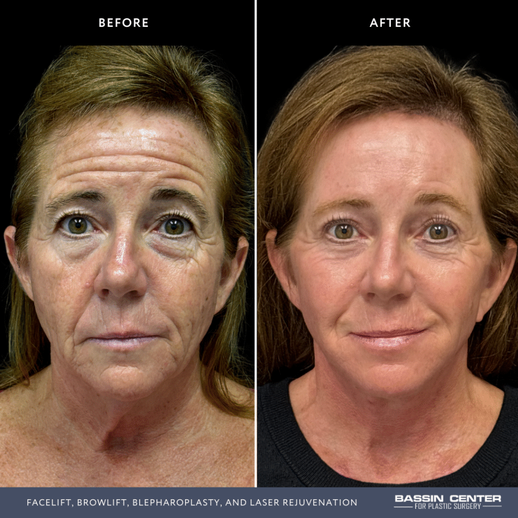Before and After Image: Facelift, Browlift, Blepharoplasty, and Laser Rejuvenation - front
