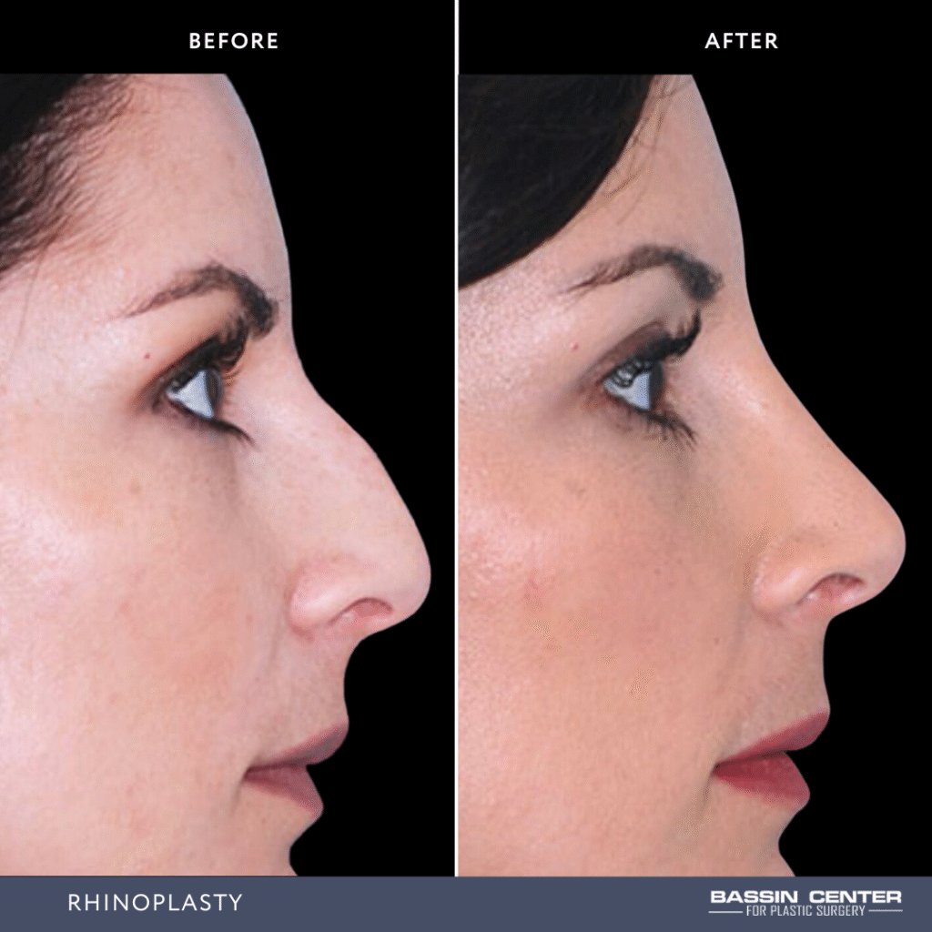 Before and After Image: Rhinoplasty - right-side