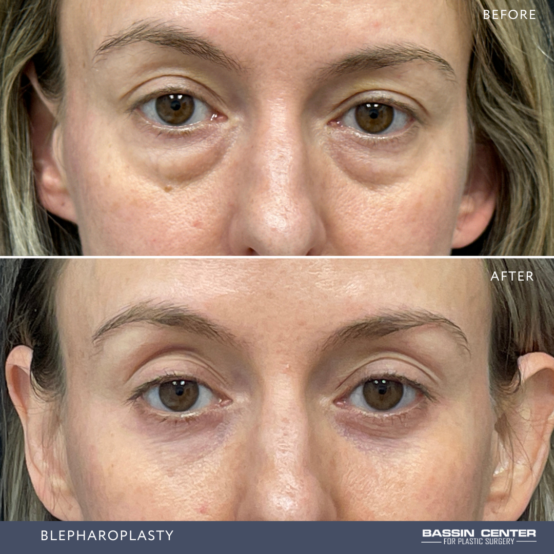 Before and After Image: Blepharoplasty - front