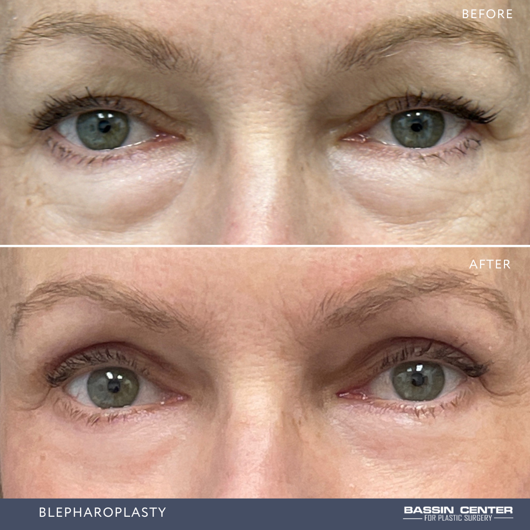 Before and After Image: Blepharoplasty - front