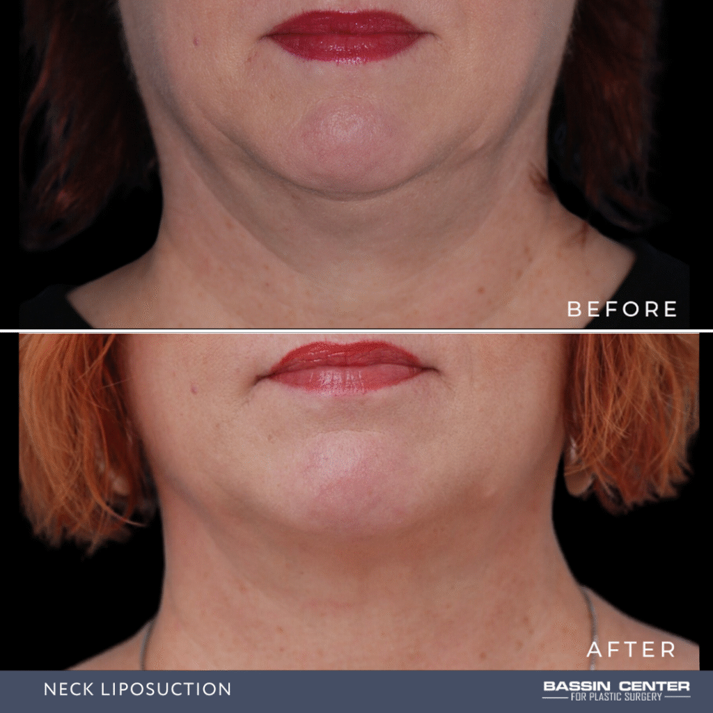 Before and After Image: Neck Liposuction - front