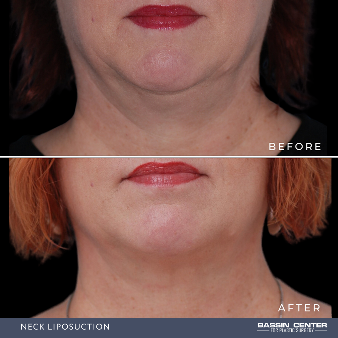 Before and After Image: Neck Liposuction - front