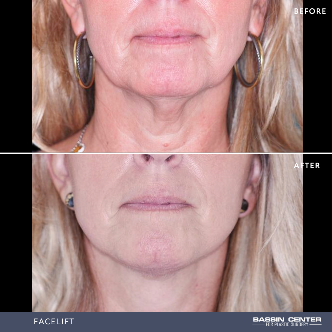 Before and After Image: Facelift - front