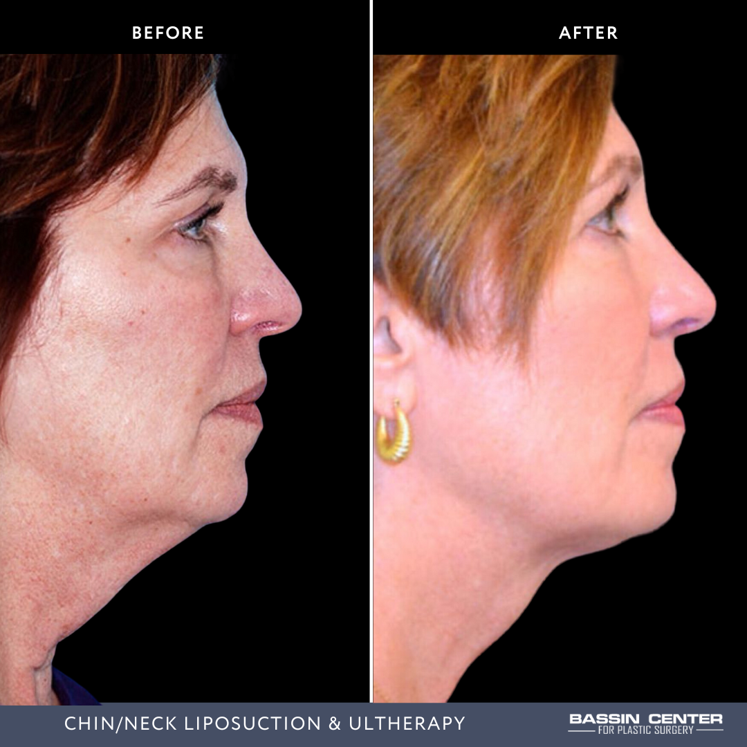 Before and After Image: Chin/Neck Liposuction & Ultherapy - right-side