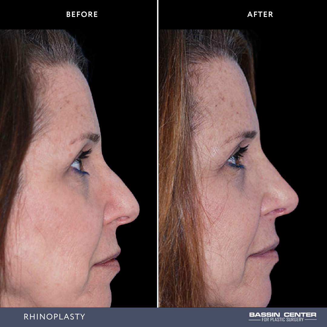 Before and After Image: Rhinoplasty - right-side