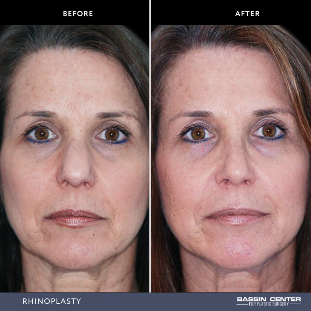 Before and After Image: Rhinoplasty - front