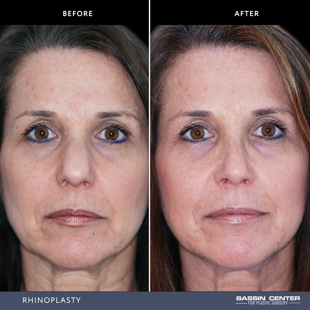 Before and After Image: Rhinoplasty - front