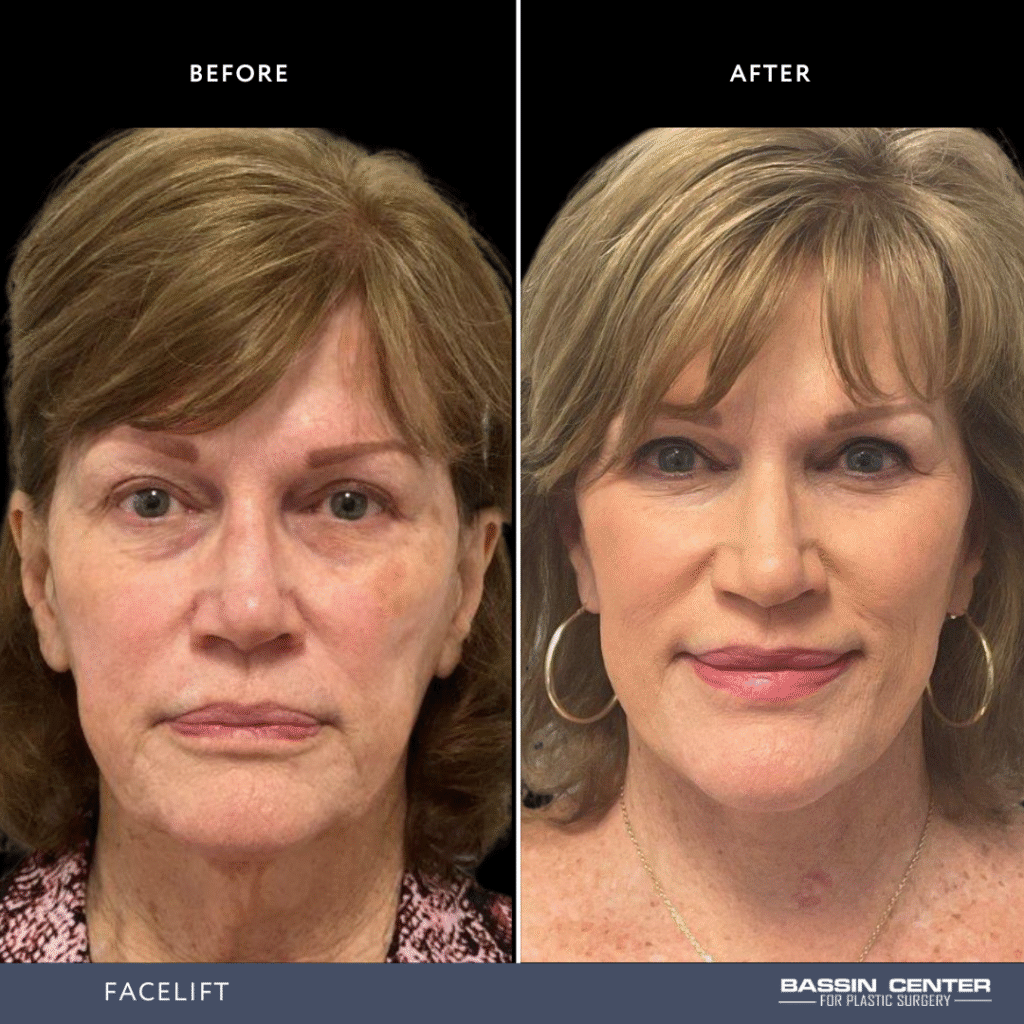 Before and After Image: Facelift - front