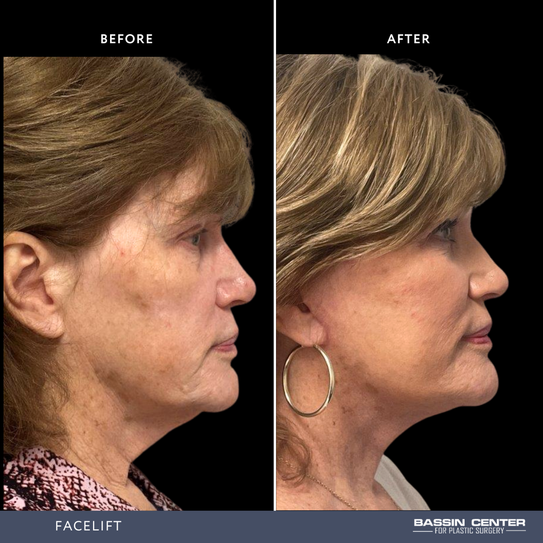 Before and After Image: Facelift - right-side