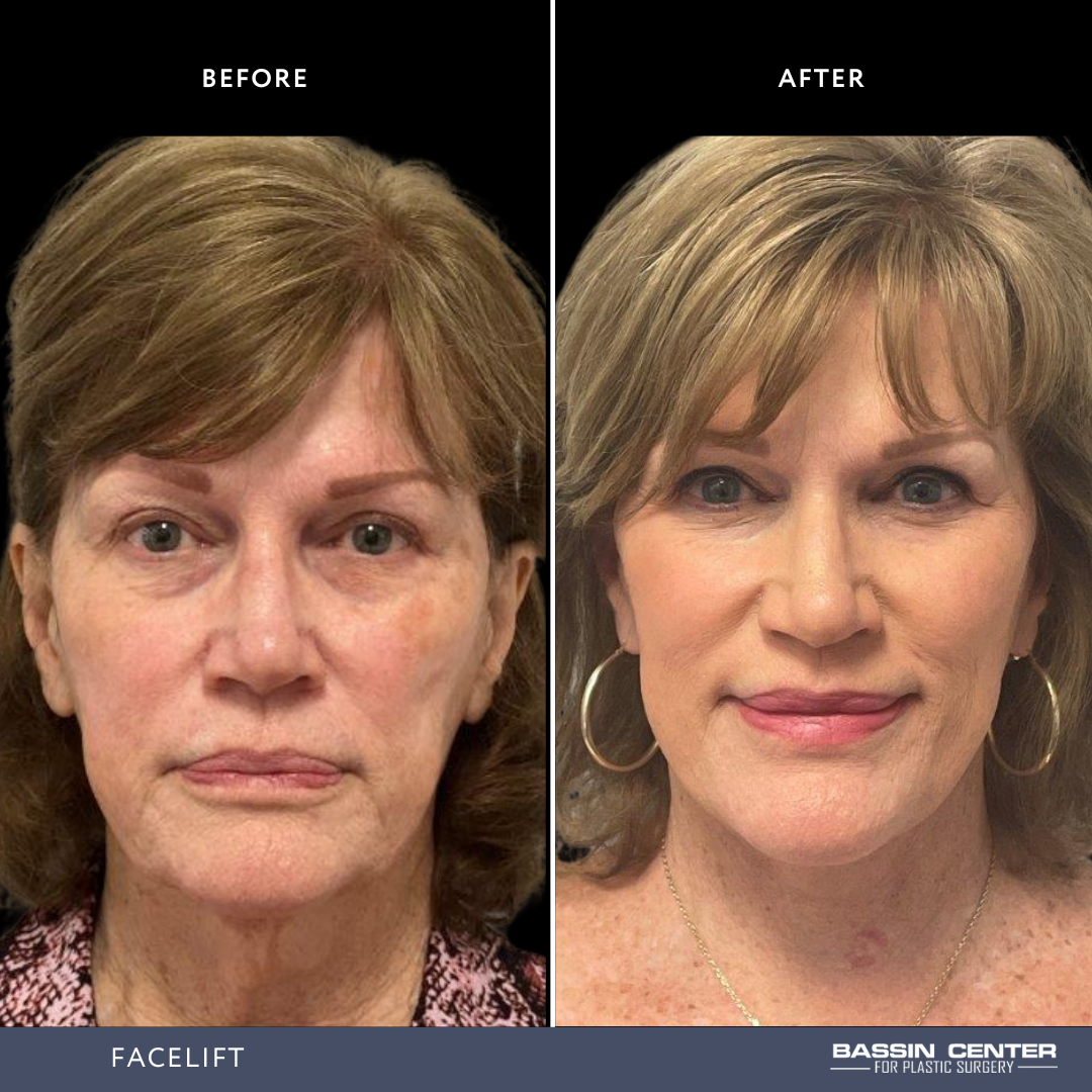 Before and After Image: Facelift - front