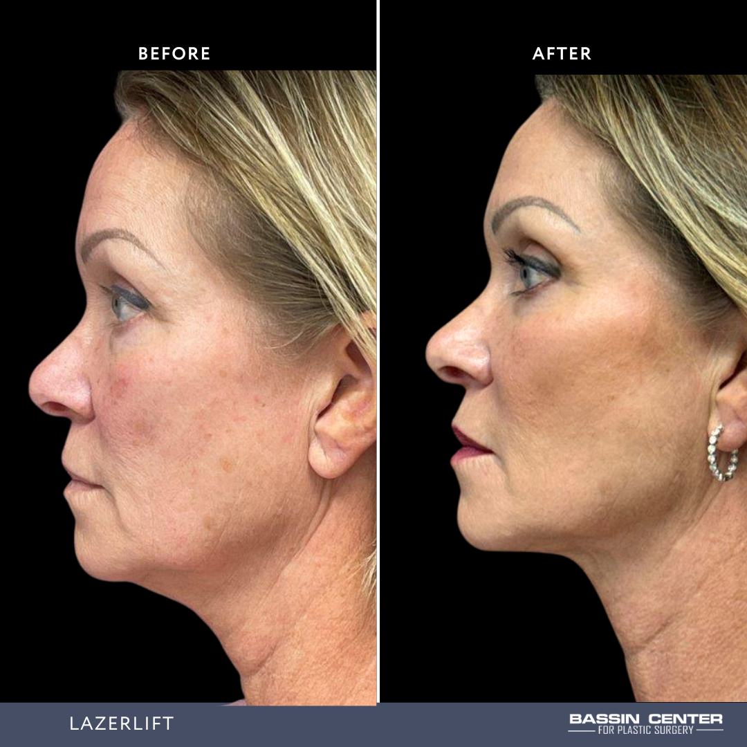 Before and After Image: Lazerlift - left-side