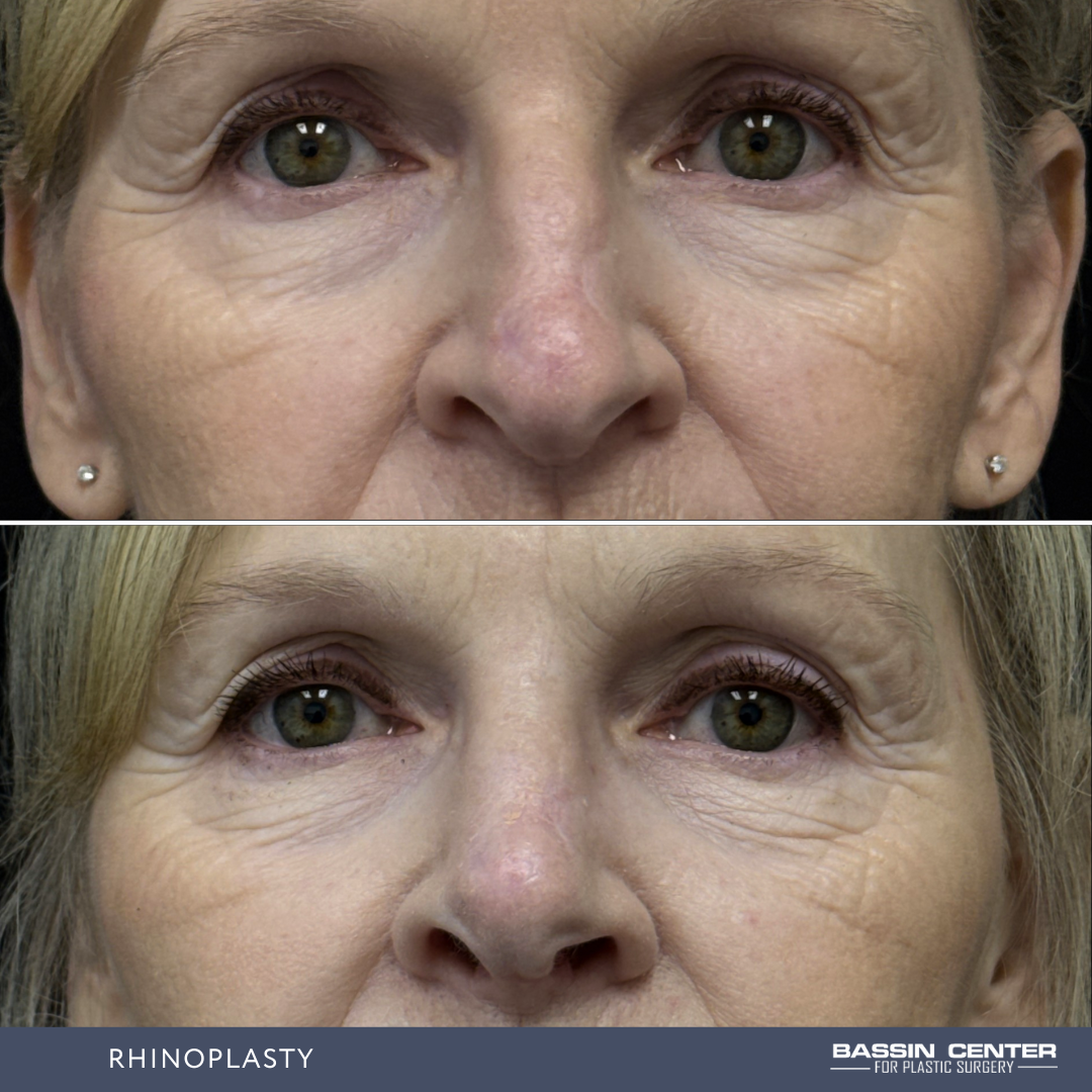 Before and After Image: Rhinoplasty - front