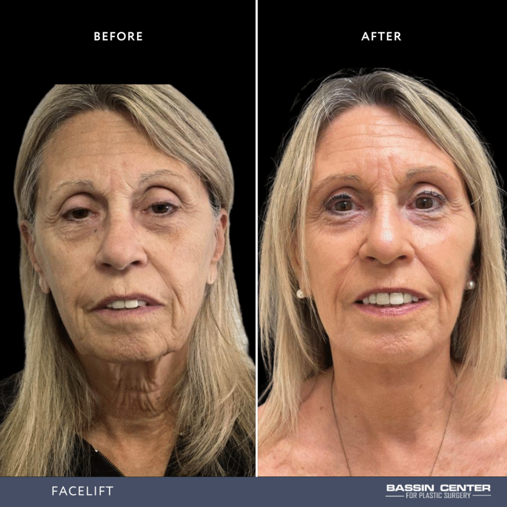 Before and After Image: Facelift - front