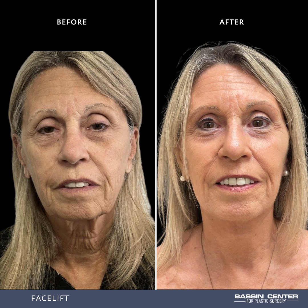 Before and After Image: Facelift - front