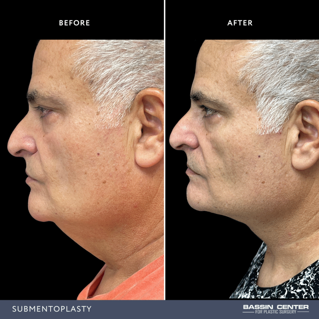 Before and After Image: Submentoplasty - left-side