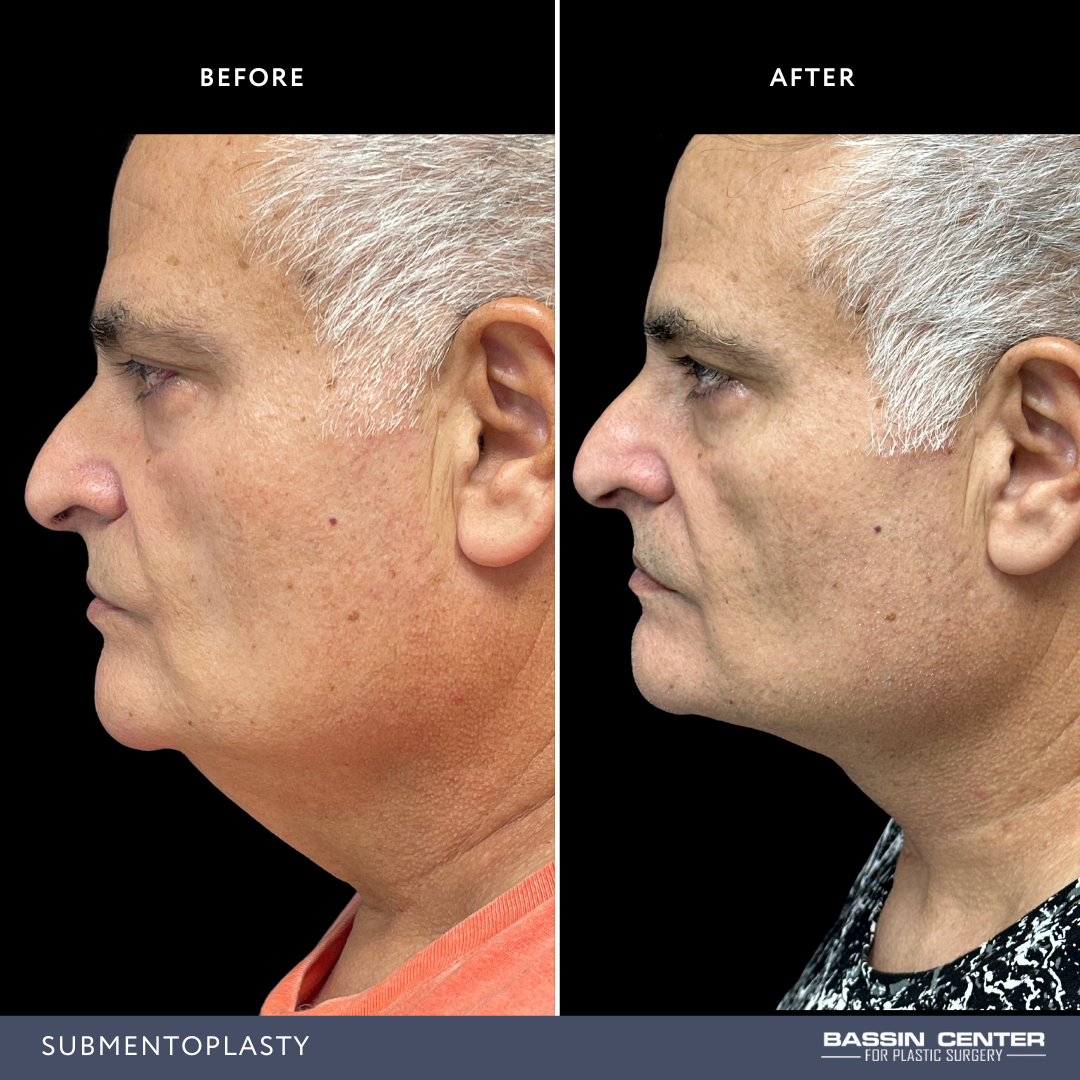 Before and After Image: Submentoplasty - left-side