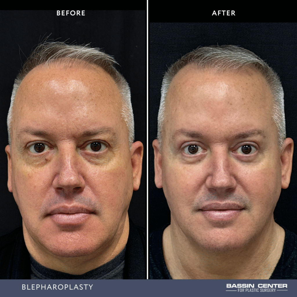 Before and After Image: Blepharoplasty - front