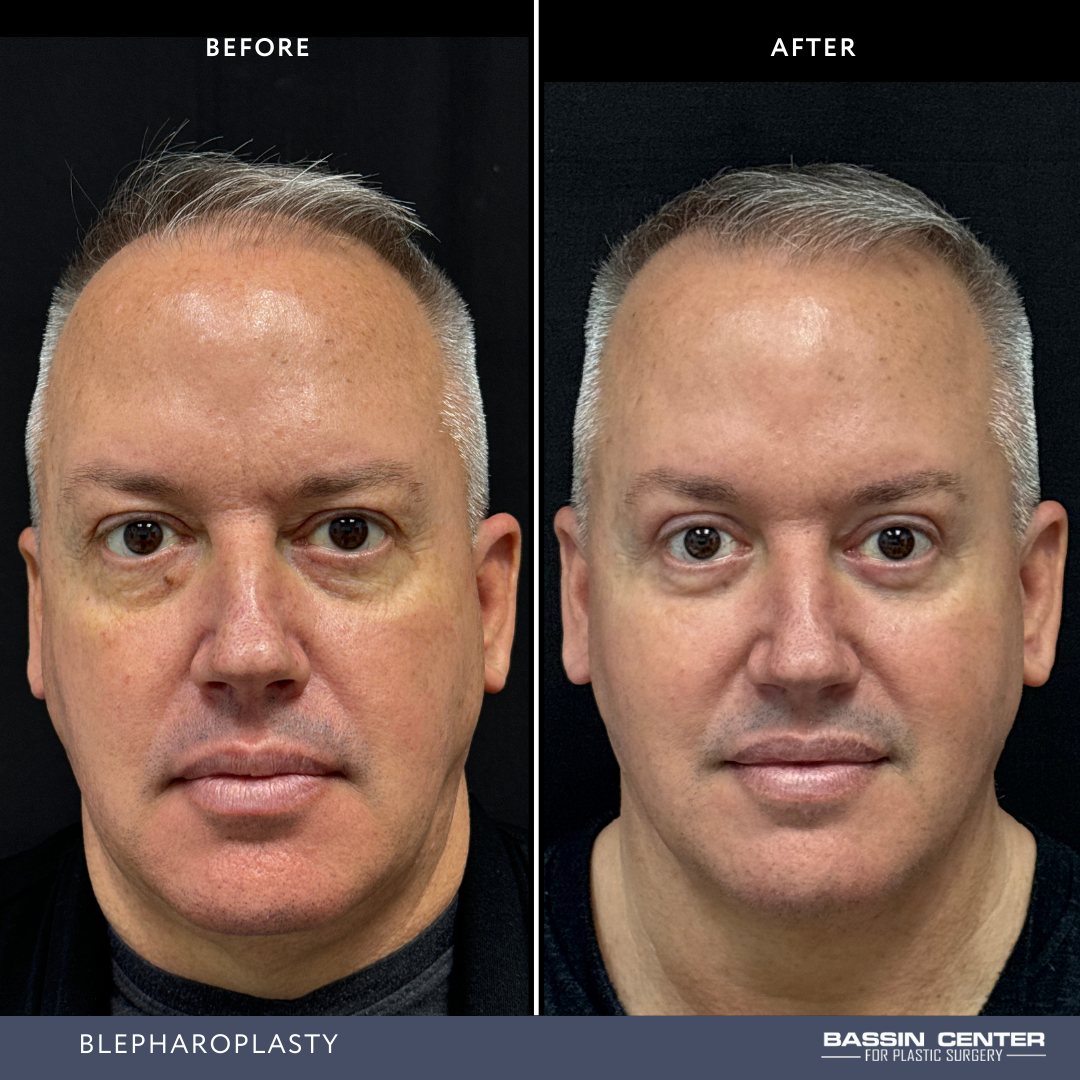 Before and After Image: Blepharoplasty - front