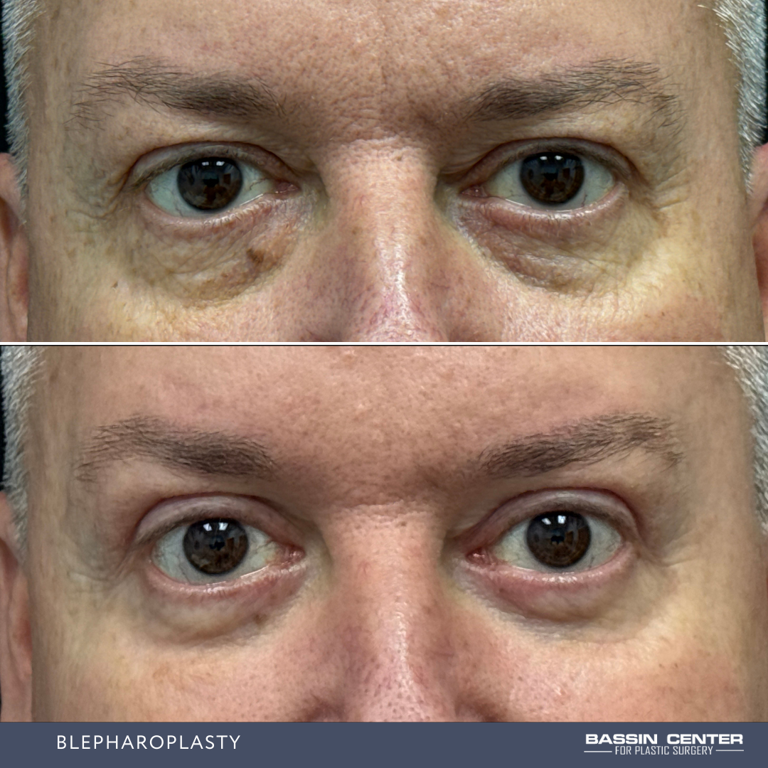 Before and After Image: Blepharoplasty - front