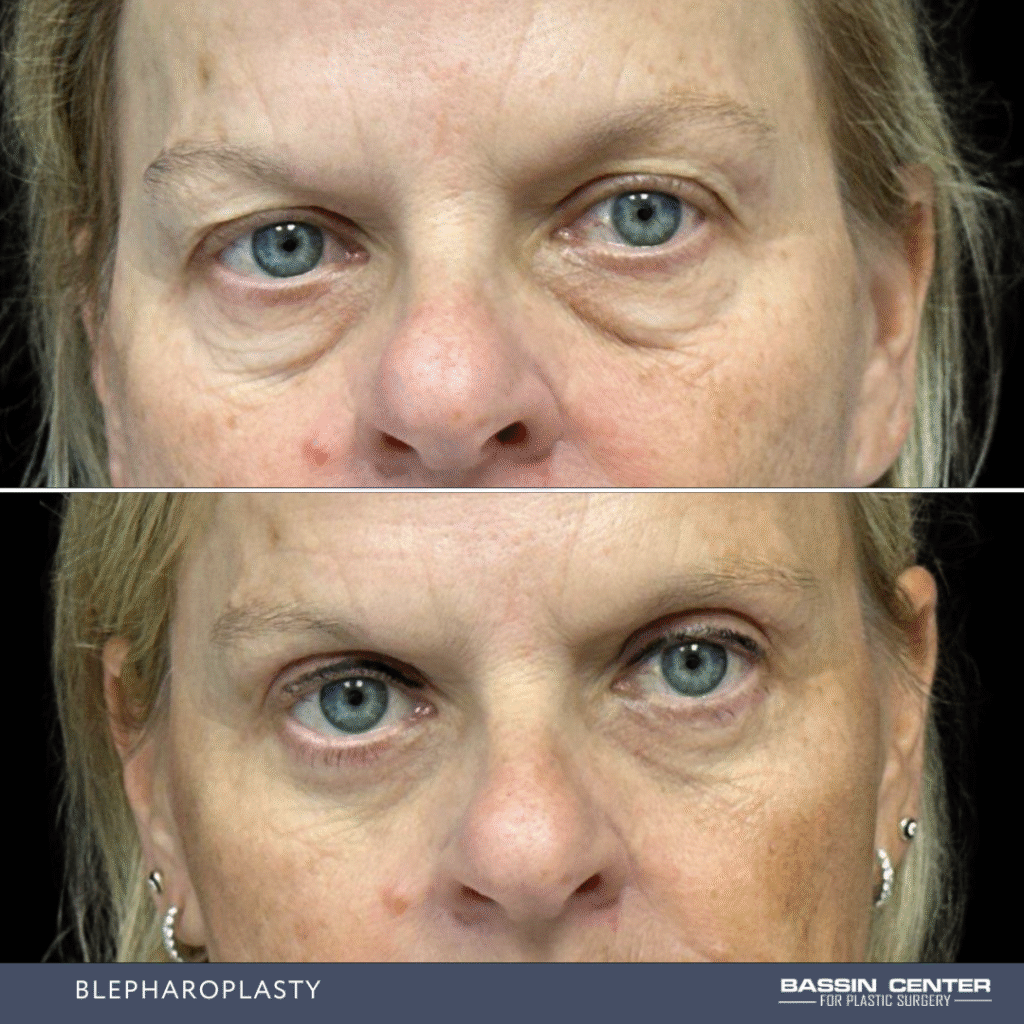 Before and After Image: Blepharoplasty - front