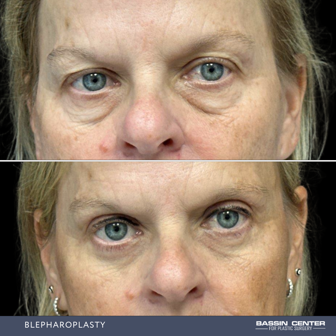 Before and After Image: Blepharoplasty - front