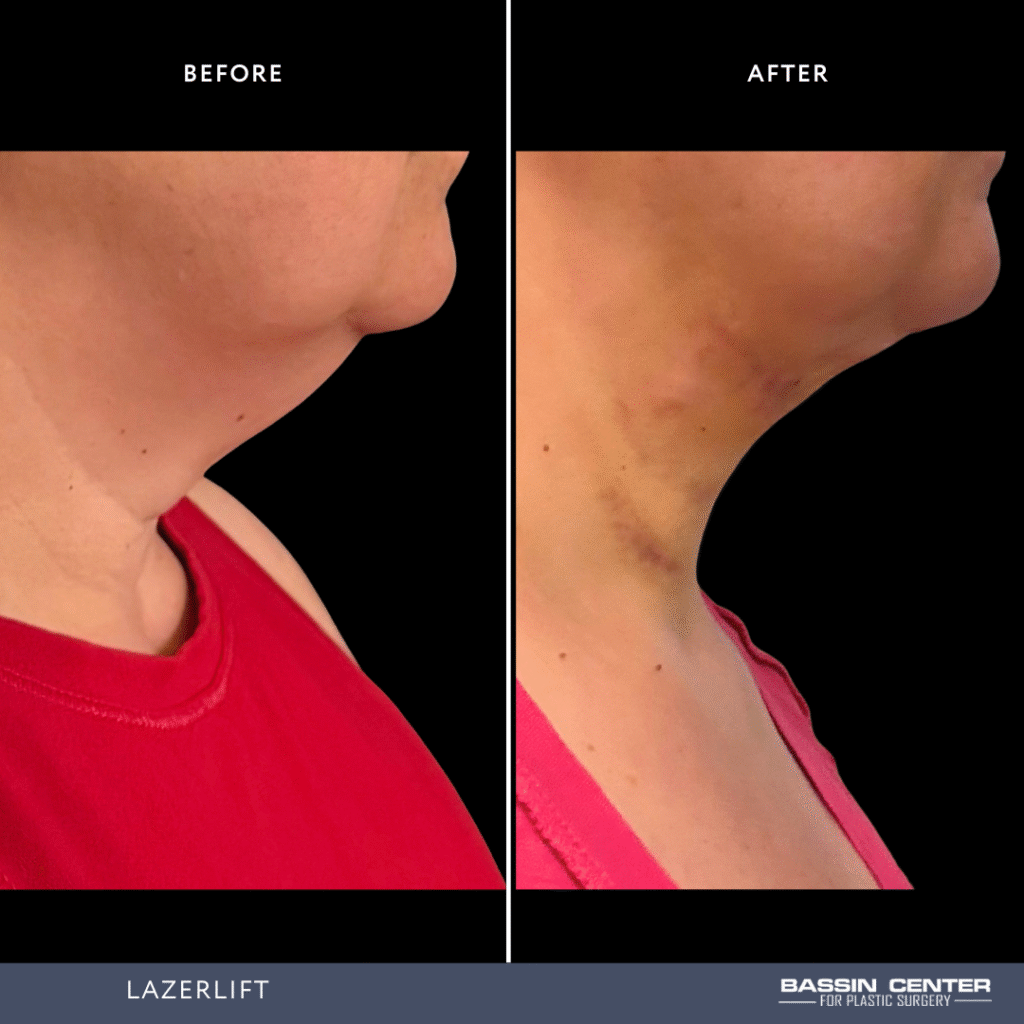 Before and After Image: Lazerlift - right-side