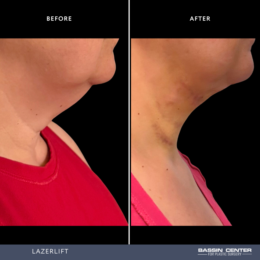Before and After Image: Lazerlift - right-side