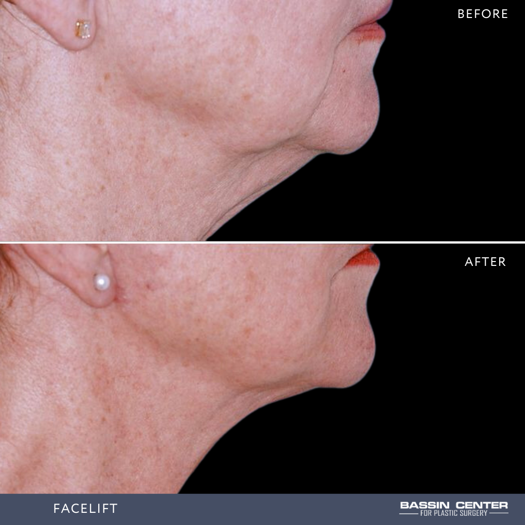 Before and After Image: Facelift - right-side