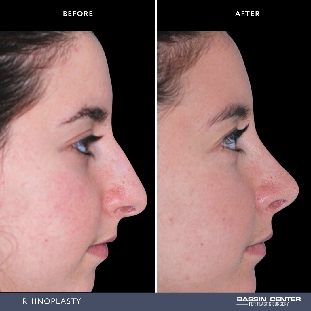 Before and After Image: Rhinoplasty - right-side