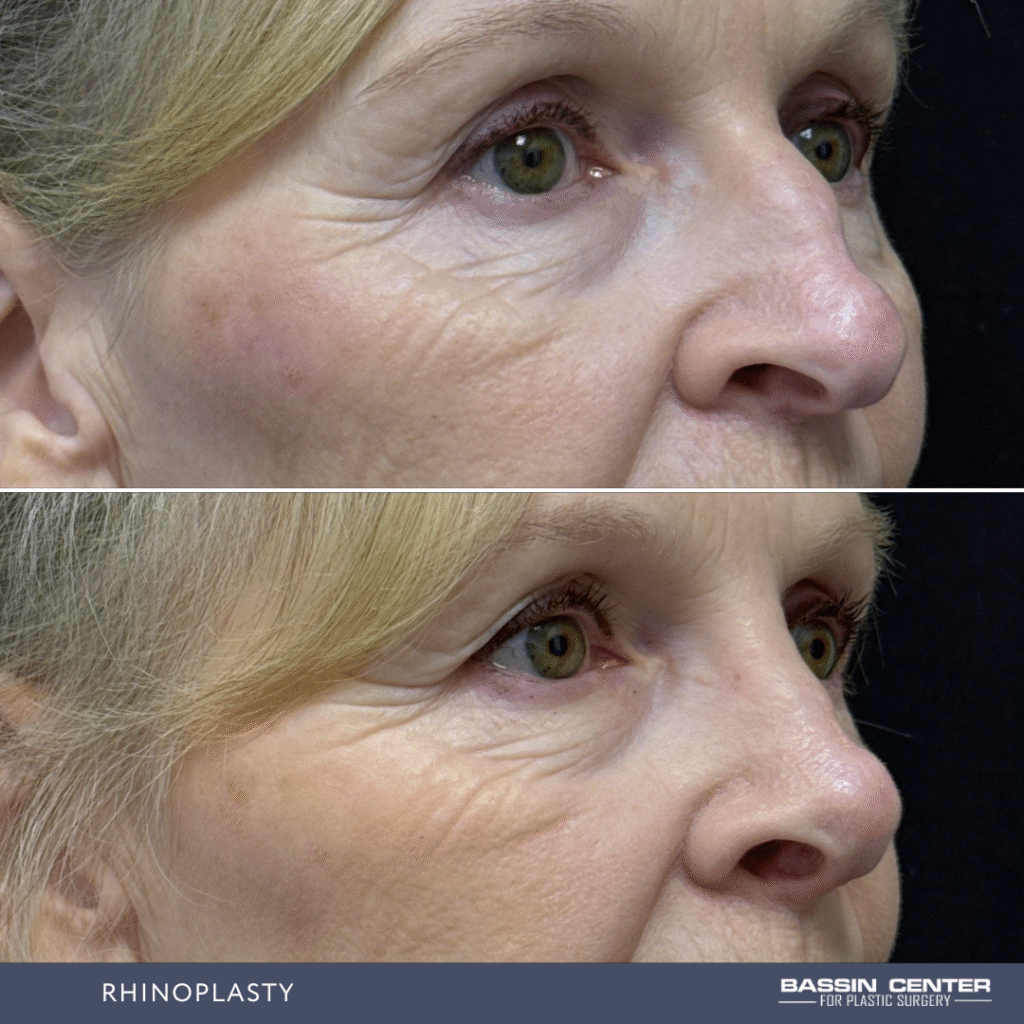 Before and After Image: Rhinoplasty - right-front-oblique