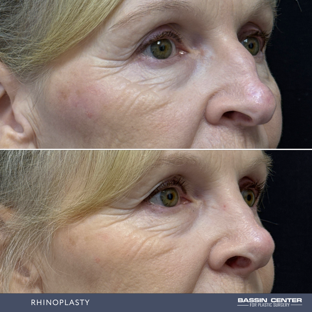 Before and After Image: Rhinoplasty - right-front-oblique