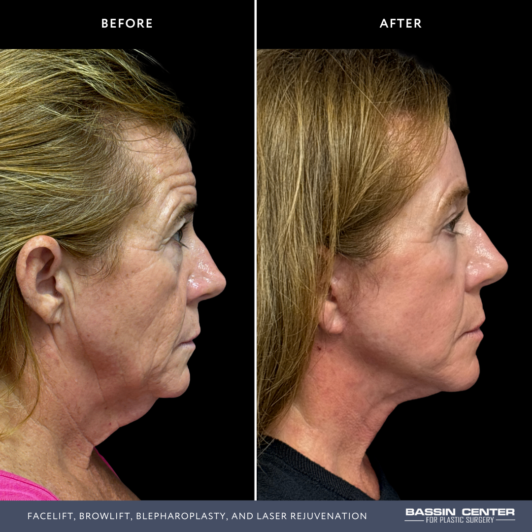 Before and After Image: Facelift, Browlift, Blepharoplasty, and Laser Rejuvenation - right-side