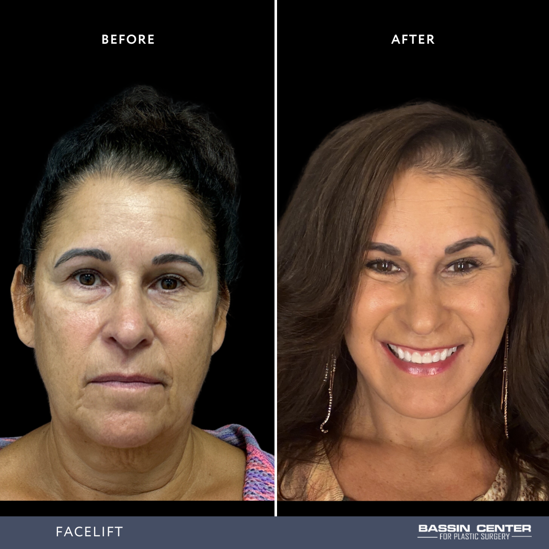 Before and After Image: Facelift - front