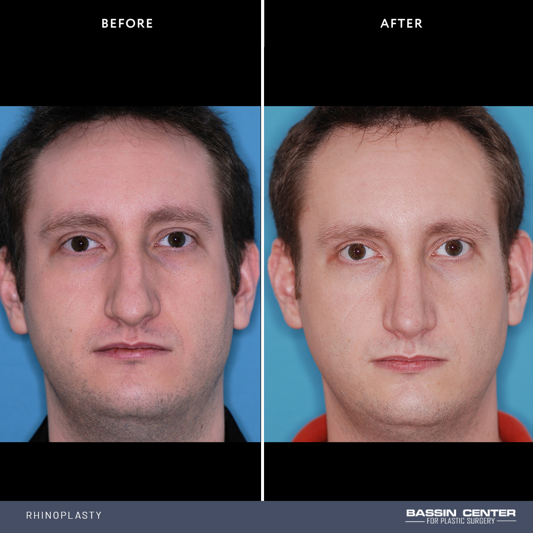 Before and After Image: Rhinoplasty - front