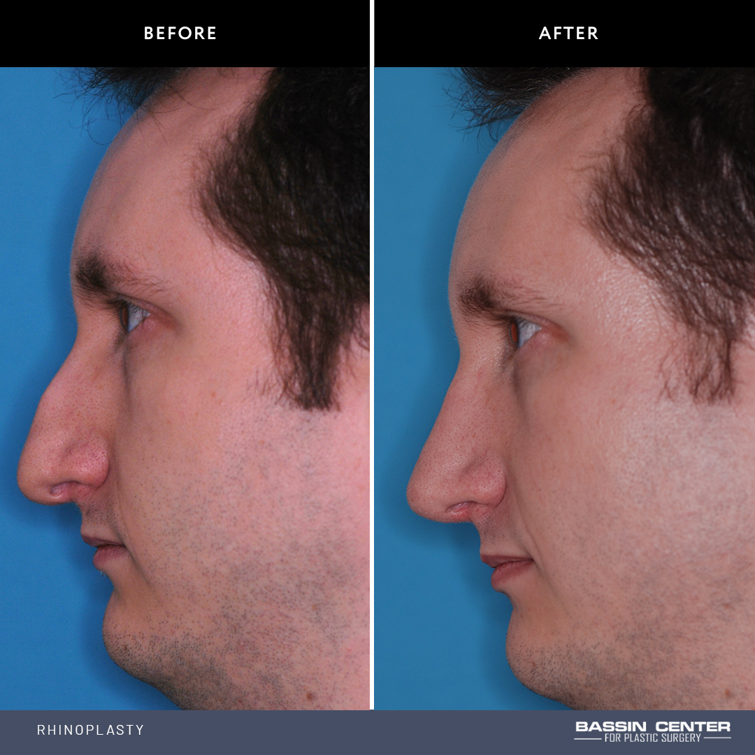 Before and After Image: Rhinoplasty - left-side