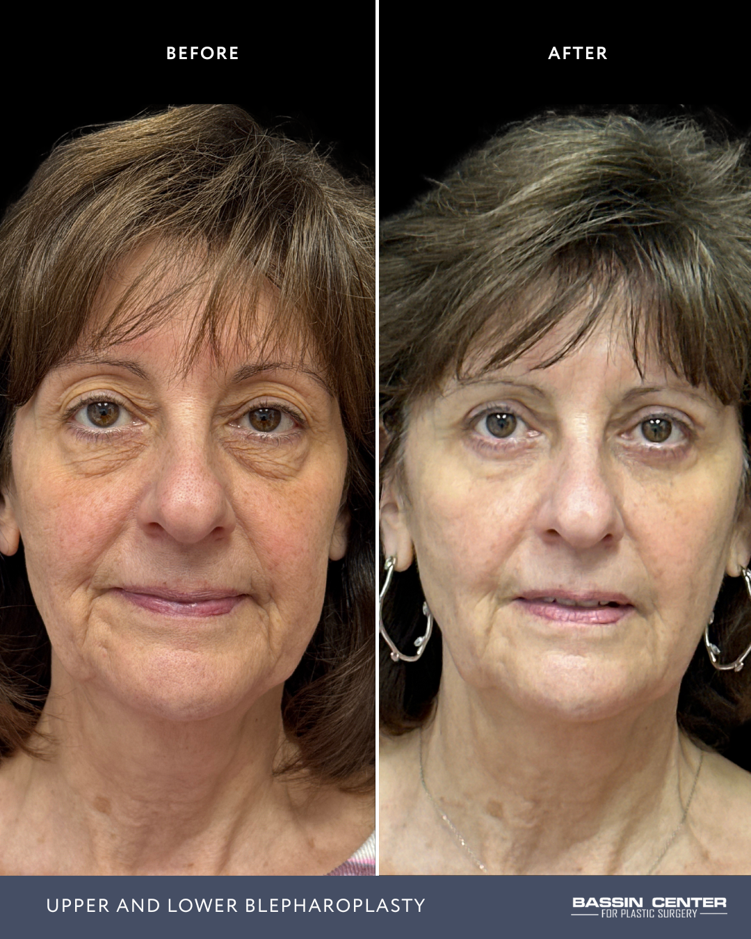 Before and After Image: Upper and Lower Blepharoplasty - front
