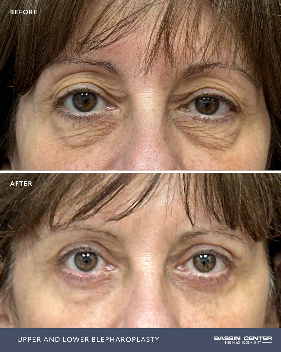 Before and After Image: Upper and Lower Blepharoplasty - front