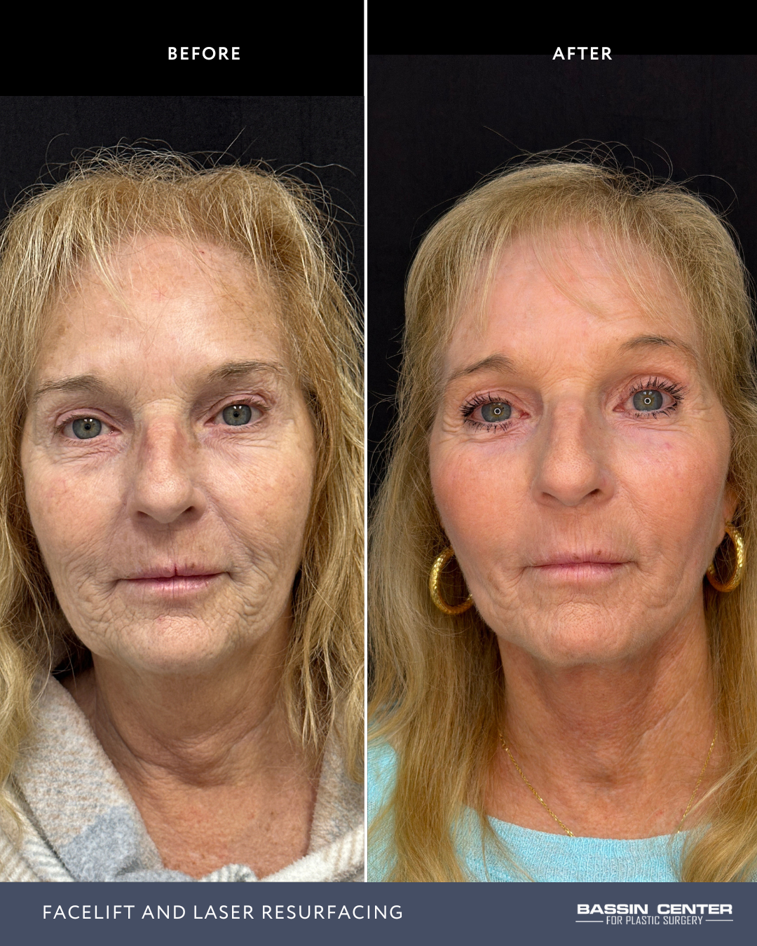 Before and After Image: Facelift and Laser Resurfacing - front