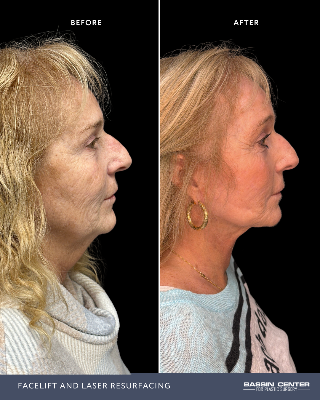 Before and After Image: Facelift and Laser Resurfacing - right-side